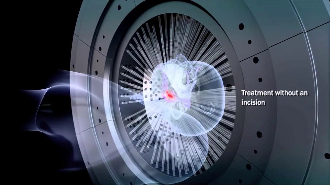 Гамма нож 2022. * Stereotactic Radiosurgery/Gamma Knife Radiosurgery. Гамма нож принцип. Аппарат гамма нож.