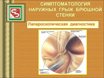 Грыжа передней брюшной стенки