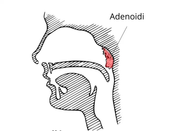 Носоглотка аденоиды 3 степени. Анатомия ЛОР органов аденоиды. Гипертрофия носоглоточной миндалины 2 ст. Анатомия носоглотки аденоиды.