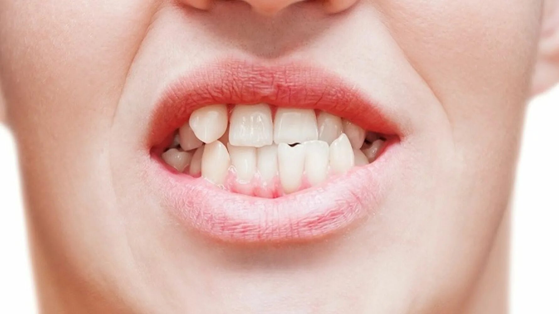 Аномалия скученности зубов. Скученность зубов в стоматологии. Скученность фронтальных зубов. Когда можно заниматься зубами