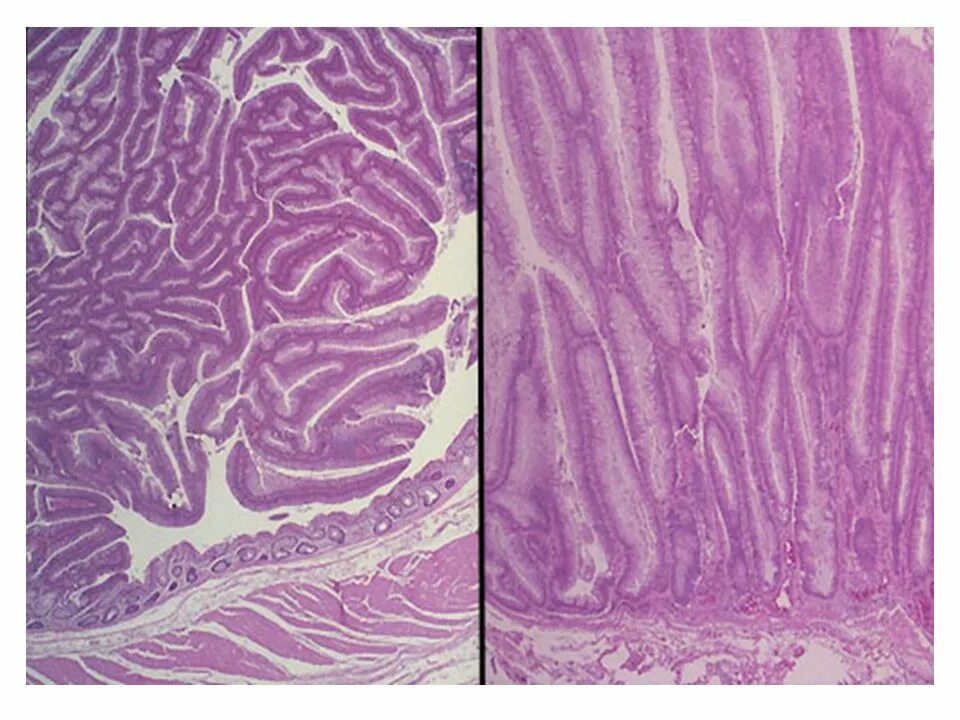 Тубулярная аденома толстой. Тубулярная аденома толстой кишки гистология. Аденома толстой кишки микропрепарат. Тубуло ворсинчатая аденома гистология. Ворсинчатая аденома толстой кишки микропрепарат.