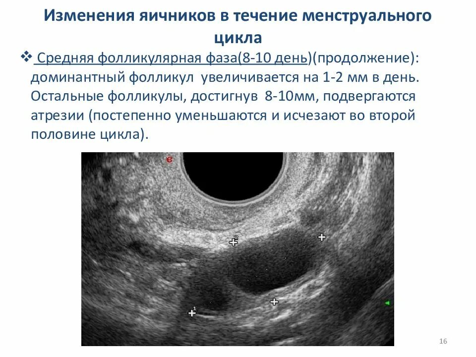 Какого размера должны быть фолликулы. Эндометрий 10 мм во второй фазе цикла. Доминантный фолликул на УЗИ. Доминантный фолликул Размеры. Размеры и нормы доминантных фолликулов.