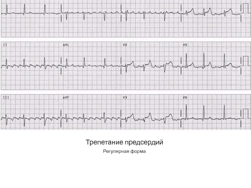 Трепетание предсердий на ЭКГ. Фибрилляция и трепетание предсердий на ЭКГ. Фибрилляция предсердий на ЭКГ. Трепетание 2:1. Формы трепетания предсердий
