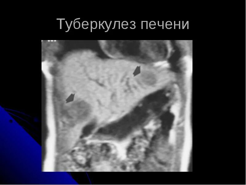 Патология селезенки. Миллиарный туберкулёз селезенки.