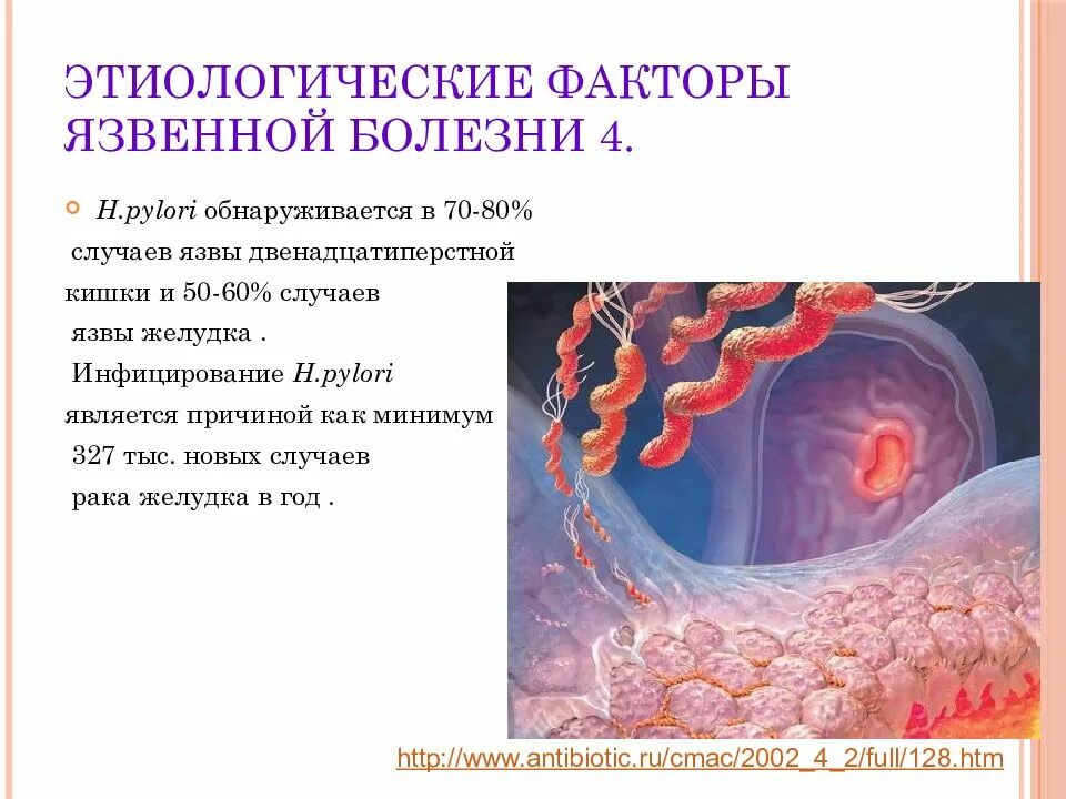 Причины появления язвы. Язва желудка патофизиология. Этиология язвы. Патогенез язвенной болезни. Этиология язвы желудка.