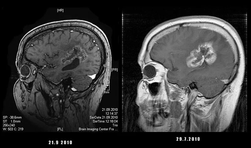 Мрт с гадолинием. Опухоль головного мозга на кт без контраста. Контрастные вещества для мрт. Мрт головного мозга с контрастированием. Черная субстанция на мрт.