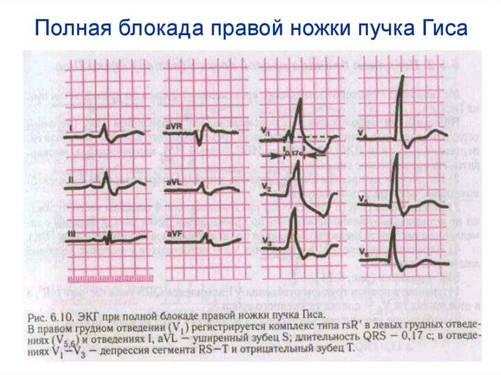 Неполная блокада лечение. Блокада правой ножки пучка Гиса на ЭКГ. Блокада правой ножки пучка Гиса и гипертрофия правого желудочка. Блокада правой ножек пучка Гиса на ЭКГ. Блокада правой ножки Гиса на ЭКГ.