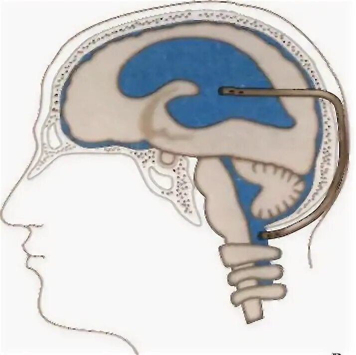 Гидроцефалия шунтирование мозга. Шунтирование головного мозга при гидроцефалии. Шунт головного мозга при гидроцефалии. Дренирование желудочков головного мозга. Вентрикулосубгалеальное шунтирование у новорожденных.