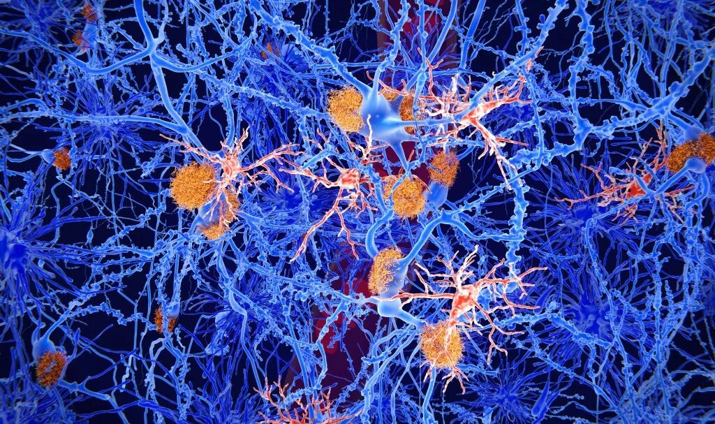 Основные клетки мозга. Нейроны головного мозга. Мозг под микроскопом. Амилоидные бляшки при болезни Альцгеймера. Амилоидные бляшки под микроскопом.