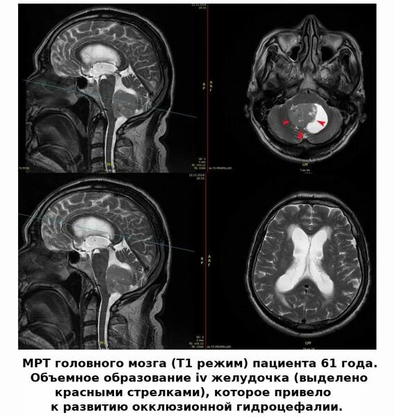 Причины гидроцефалии мозга. Гидроцефалия головного мозга на кт. Наружная гидроцефалия головного мозга мрт. Посттравматическая гидроцефалия мрт. Мрт снимки наружная гидроцефалия.