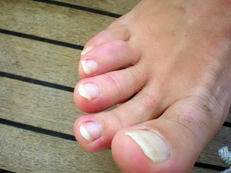 на сколько вырастают ногти на ногах. на сколько вырастают ногти на ногах. ногти на ногах до педикюра. искривленный ноготь на ноге. грибок ногтей на ногах признаки.