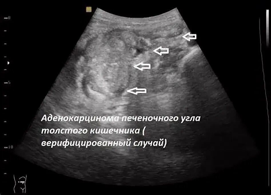 Инвагинация кишечника на узи. Узи кишечника (эндоректальная ультрасонография). Инвагинация тонкого кишечника узи. Жидкость в брюшной полости на узи. Дивертикулёз сигмовидной кишки на узи.