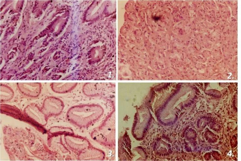 Признаки атрофией слизистой оболочки. Фибринозный гастрит патологическая анатомия. Атрофический гастрит патанатомия. Фибринозный острый гастрит. Хронический атрофический гастрит гистология.
