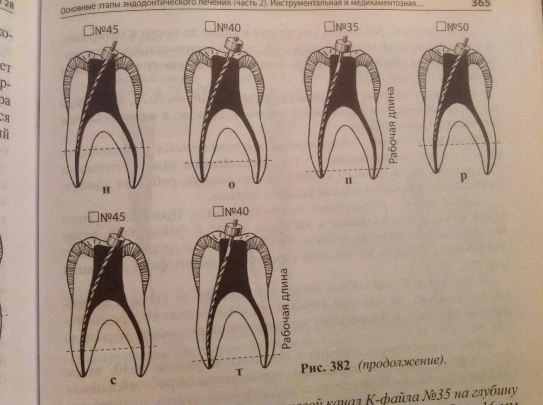 Этапы эндодонтической обработки корневых каналов при периодонтите.. Этапы обработки канала зуба. Этапы эндодонтического лечения зуба. Осложнения в эндодонтии. Этапы эндодонтического лечения