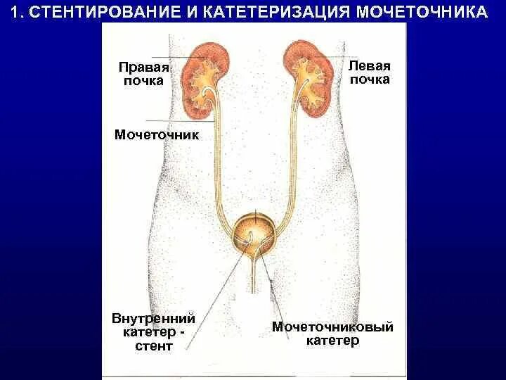 Катетер в мочеточник