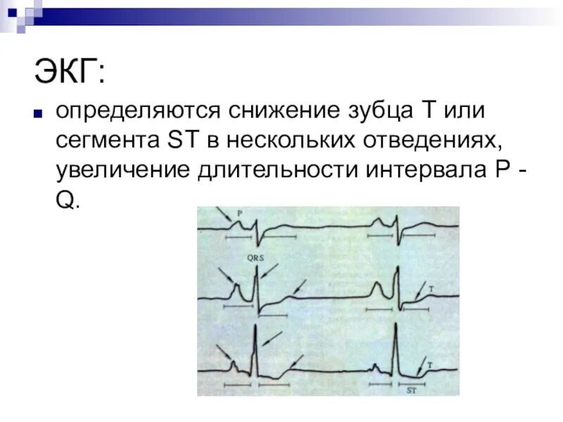 Изменение сегмента st и зубца. Экг при миокардите у взрослых. изменения на экг при миокардите. при миокардите возможны следующие изменения на экг. снижение зубца т на экг.