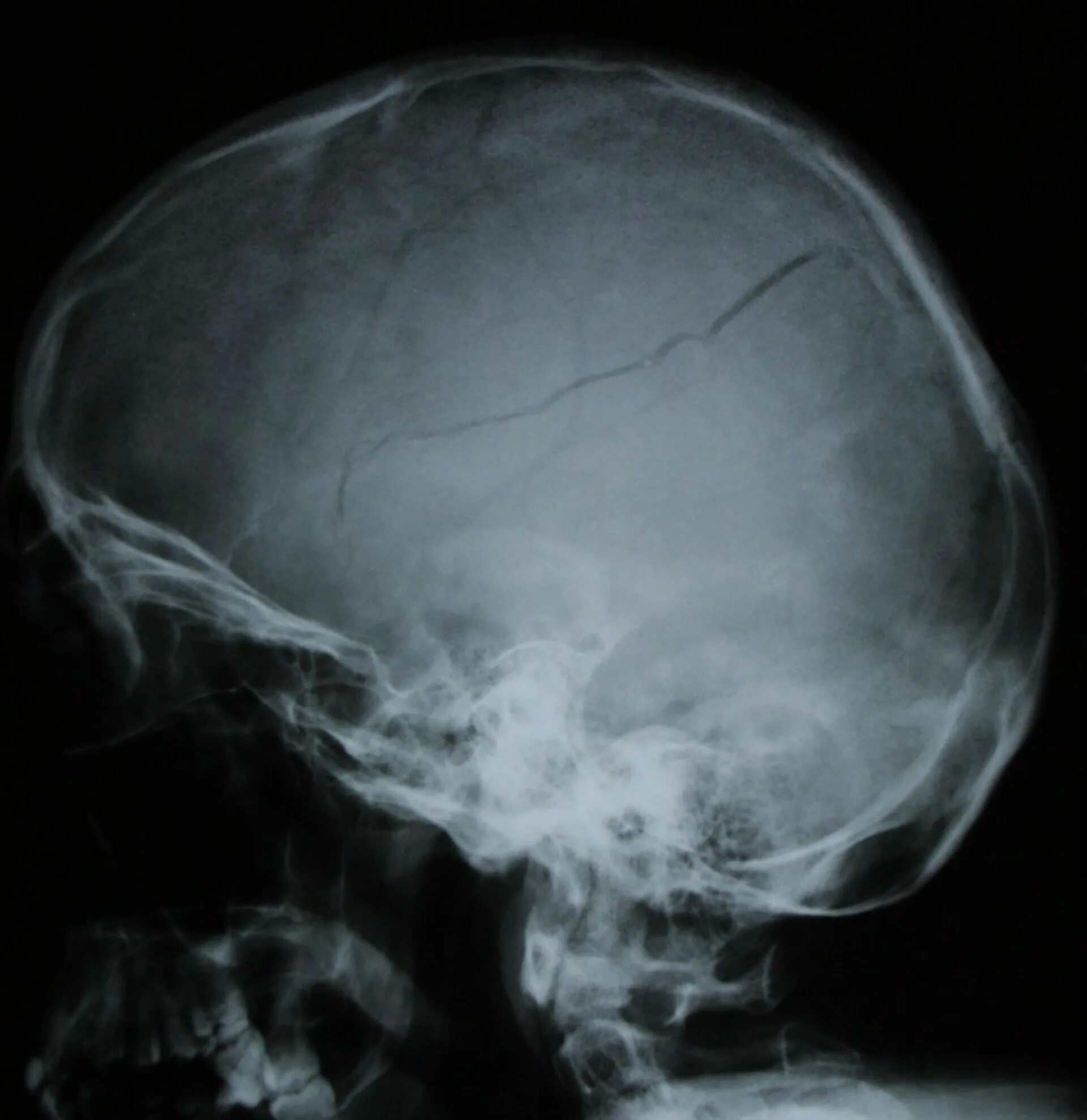 Трещина в голове. Оскольчатый перелом черепа рентген. Перелом затылочной кости черепа рентген. Паутинообразный перелом черепа. Перелом костей черепа рентген.