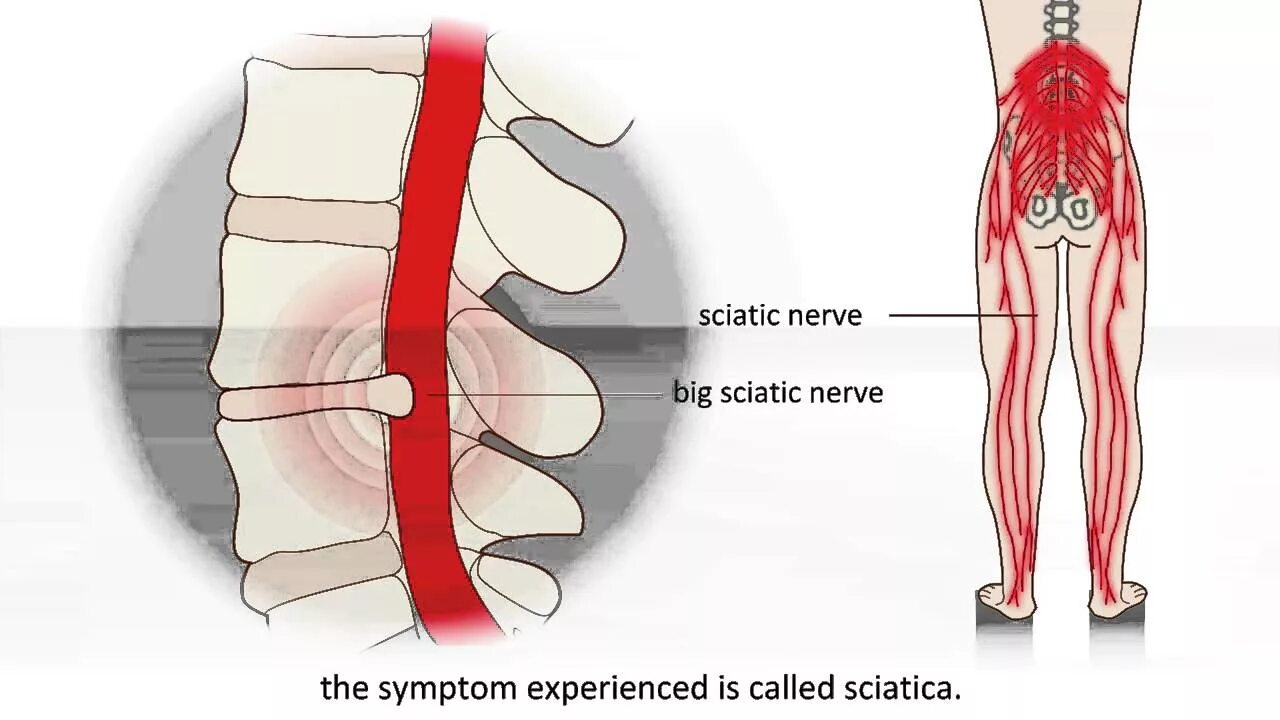 Зажало нерв в пояснице. Седалищный нерв л5 с1. Нерв в пояснице. Защемление поясничного нерва. Нервы поясницы.
