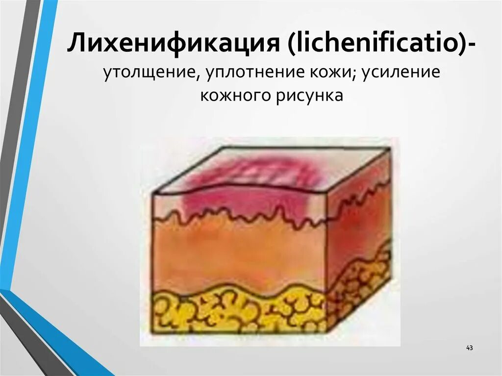 Вторичные морфологические элементы кожи лихенификация. Лихенификация дерматовенерология. Элементы кожной сыпи лихенификация. Усиление кожного рисунка. Экскориация морфологический элемент.
