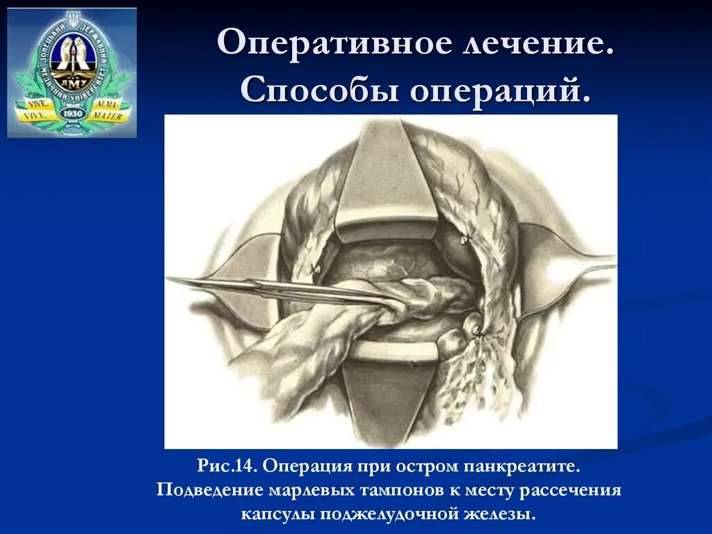 Оперативное хирургическое лечение. Острый панкреатит Оперативная хирургия. Хирургическое лечение острого панкреатита. Операции при остром панкреатите.