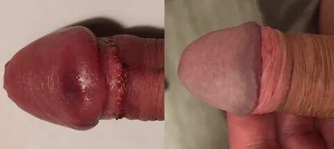 Увеличение головки: фото до и после.