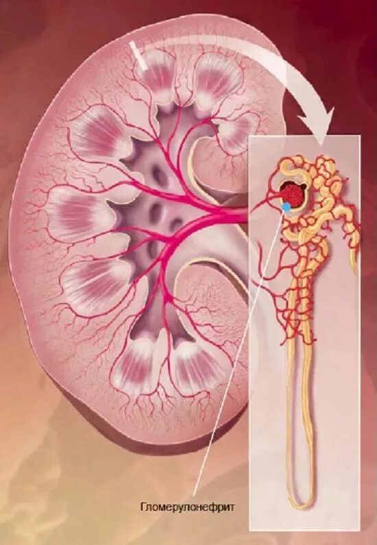 Острые почечные заболевания. Клубочки почек гломерулонефрит. Болезни Берже iga-нефропатия. Почка пораженная гломерулонефритом. Хронический гломерулонефрит болезнь Берже.