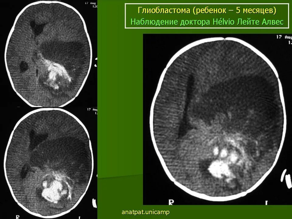 Лучевая терапия при глиобластоме головного. Лучевая терапия глиобластома. Стереотаксическая радиохирургия головного мозга. Анапластическая астроцитома пэт-кт. Радиотерапия головного мозга.