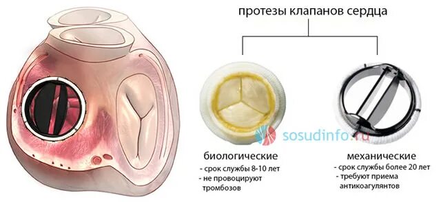Типы искусственных клапанов сердца. Применение