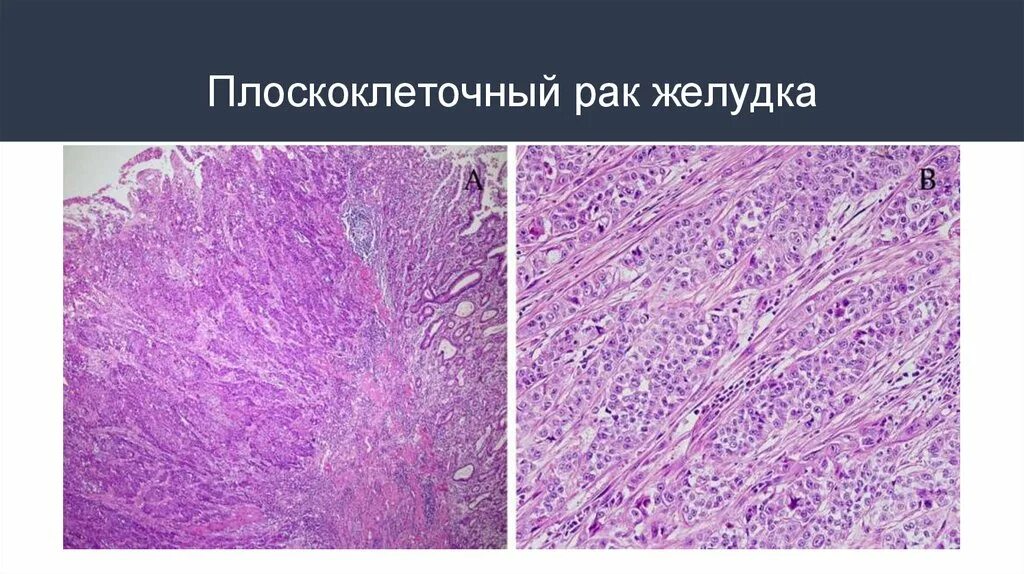 Микропрепарат плоскоклеточная папиллома пищевода. Плоскоклеточная папиллома гистология. Плоскоклеточная папиллома кожи гистология. Аденокарцинома мочевого пузыря гистология. Низкодифференцированный плоскоклеточный рак