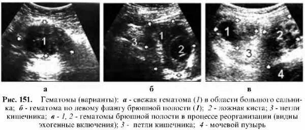 Ретроамниотическая гематома ретрохориальная гематома. Ретроперитонеальная гематома. УЗИ картина гематомы мягких тканей. Гематома в стадии организации