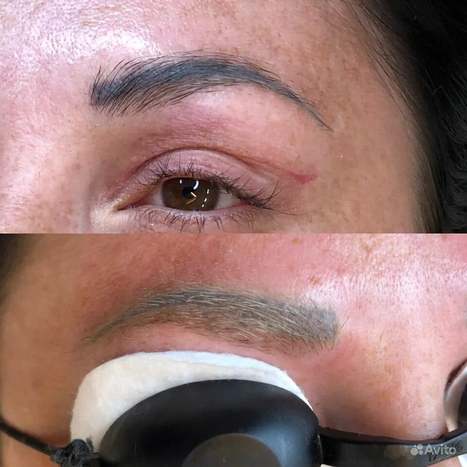 удаление перманентного макияжа бровей лазером. сведение татуажа бровей лазером. перманентный макияж бровей. удаление тату бровей лазером. лазерное удаление татуажа бровей.