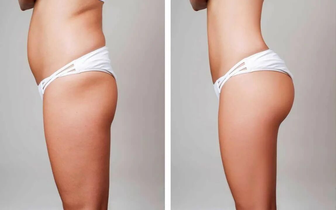 Butt lift. Липосакция липоскульптура. Приседания для увеличения бедер. Идеальные ягодицы фото. Bbl butt lift.