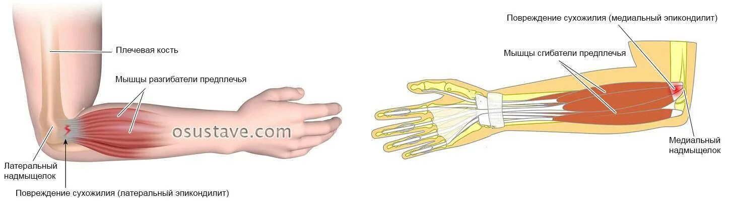Почему болят локтевые сгибы. Эпикондилит локтевого сустава. Медиальный эпикондилит сухожилия. Медиальный и латеральный эпикондилит. Латеральный или медиальный эпикондилит.