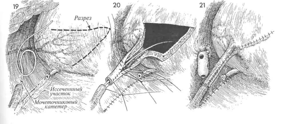 Операция Политано-Лидбеттера. Анастомоз мочевого пузыря. Пересадка мочеточника в мочевой пузырь. Надлобковый свищ мочевого пузыря. Операция мочевого канала