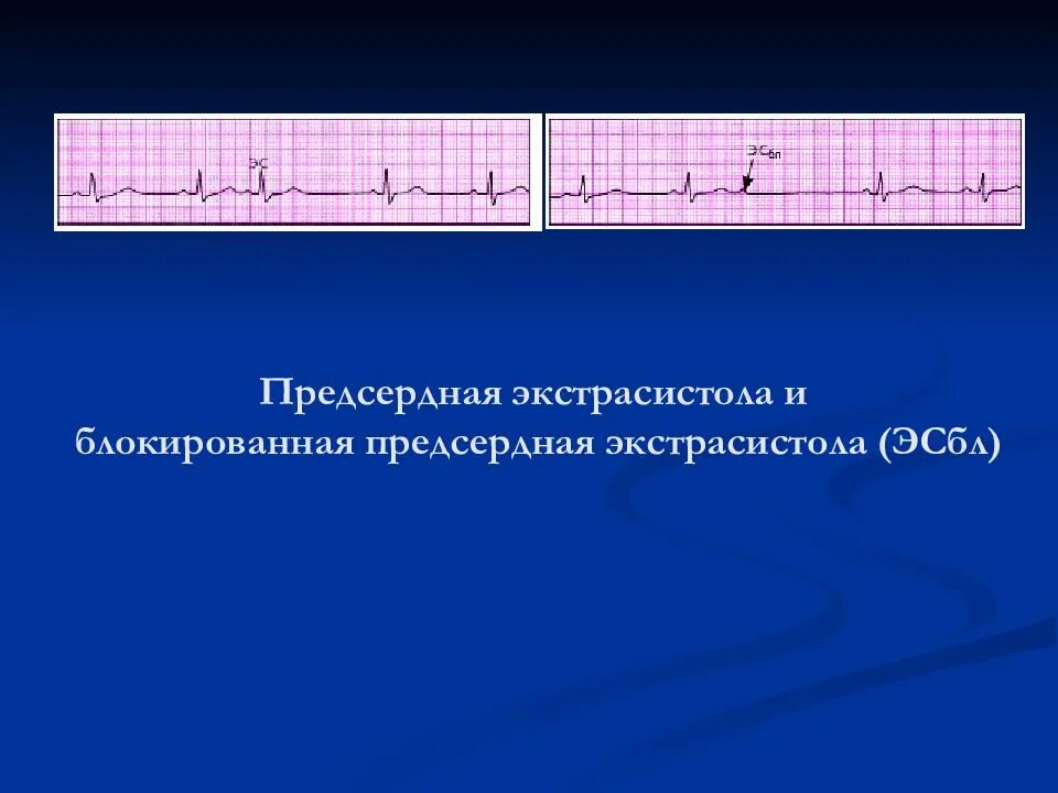 Блокированная экстрасистола ЭКГ. Блокированные предсердные экстрасистолы на ЭКГ. Парная блокированная предсердная экстрасистолия. Блокированная желудочковая экстрасистола. Блокированные экстрасистолы