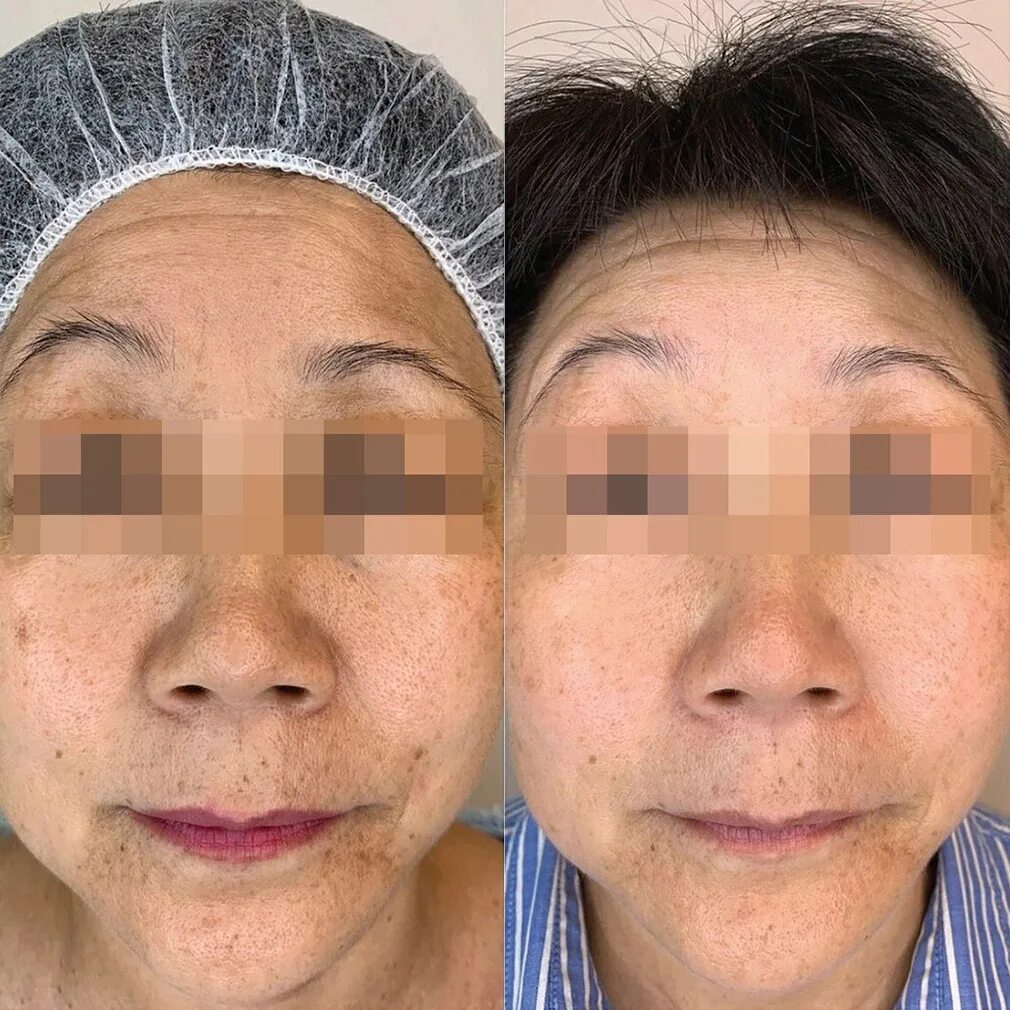 botox for under eye wrinkles non invasive - YouTube