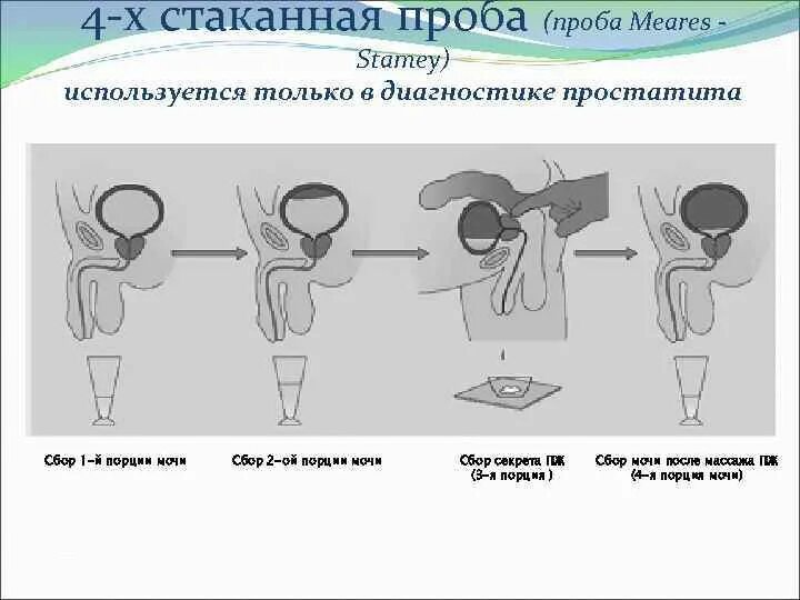 Схема выполнения массажа простаты. Проба Stamey Meares. 4-Х стаканная проба. 4х стаканная проба мочи.