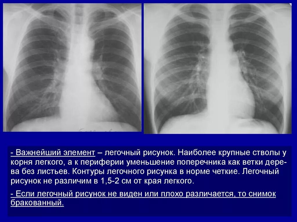 Прикорневой отдел легких