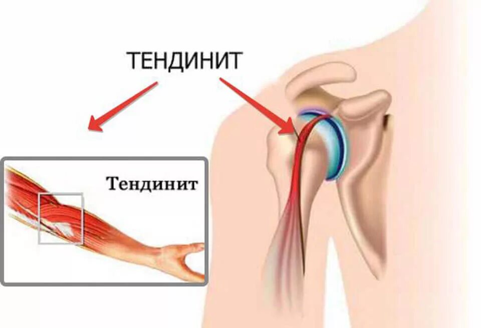 Тендинит плечевых сухожилий