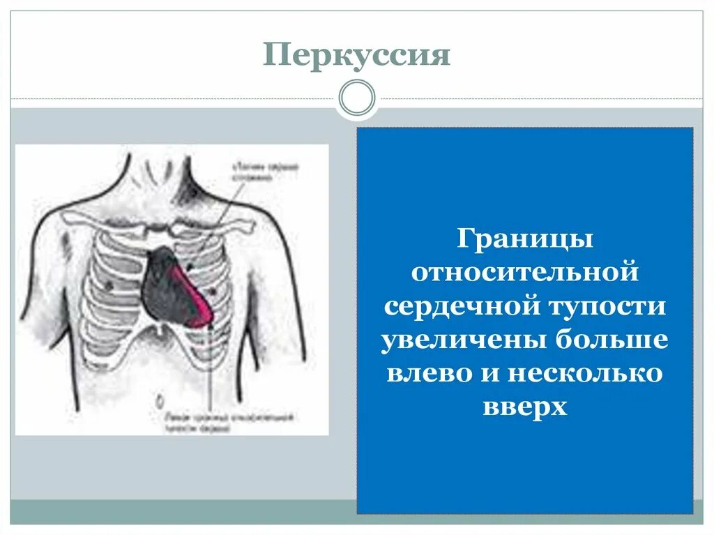 Перкуторное расширение границ сердца. Перкуссия границ относительной сердечной тупости. Перкуссия сердца границы. Границы относительной сердечной.