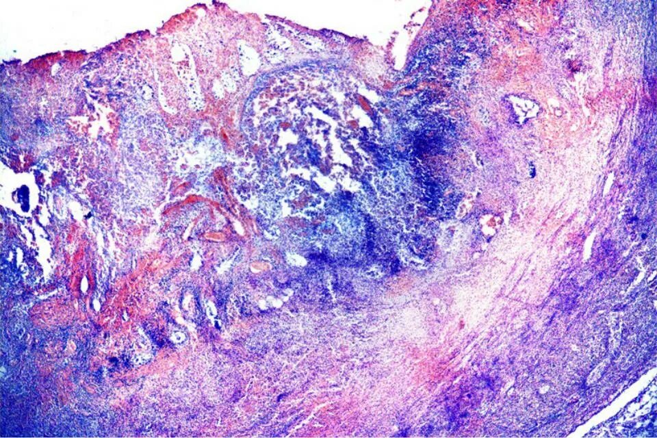 Флегмонозно язвенный аппендицит. Флегмонозный холецистит гистология. Флегмонозный аппендицит микропрепарат патанатомия. Острый холецистит патанатомия гистология. Флегмонозно язвенный аппендицит микропрепарат.