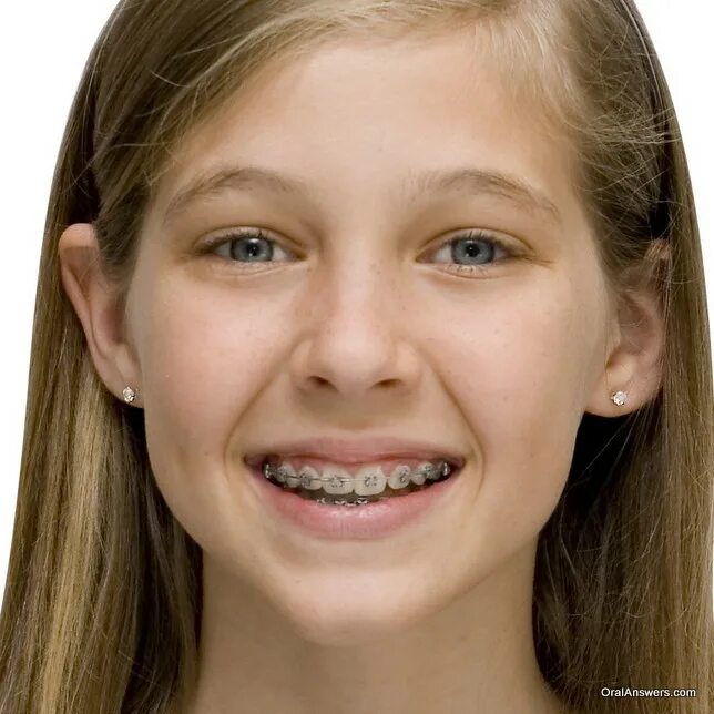 14 Лет Braces. Девушка с брекетами и в очках. Close young