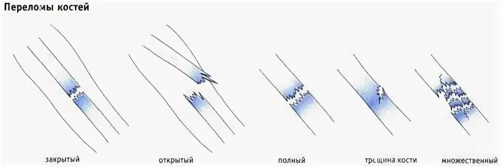 Как отличить трещину. Полный и неполный перелом. Полный и не полный передом. Неполный перелом трещина. Полный и частичный перелом.