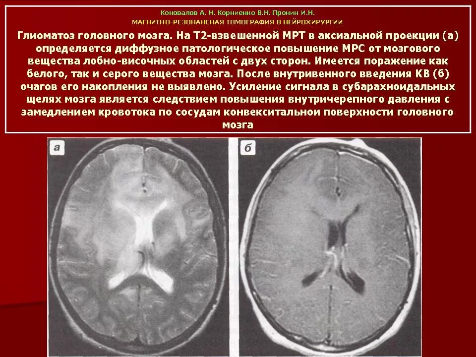 Глиоз мозга причины. Глиоматоз мозга на кт. Глиоматоз головного мозга мрт. Глиома головного мозга кт. Глиоматоз головного мозга Продолжительность жизни.