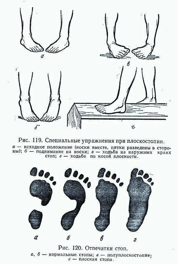 Степени вальгусной деформации. Упражнения при вальгусной деформации стопы у детей 7 лет. лфк при вальгусной деформации стопы у детей. гимнастика при вальгусе стопы у детей 4. упражнения для стопы при вальгусной деформации у детей картинки.