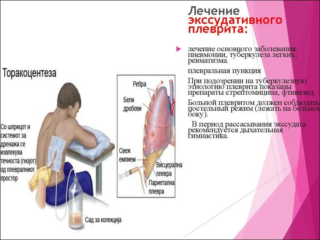 Синдром поражения плевры симптомы. Алеврит. Заболевание плевры легких. Вода в легких у человека