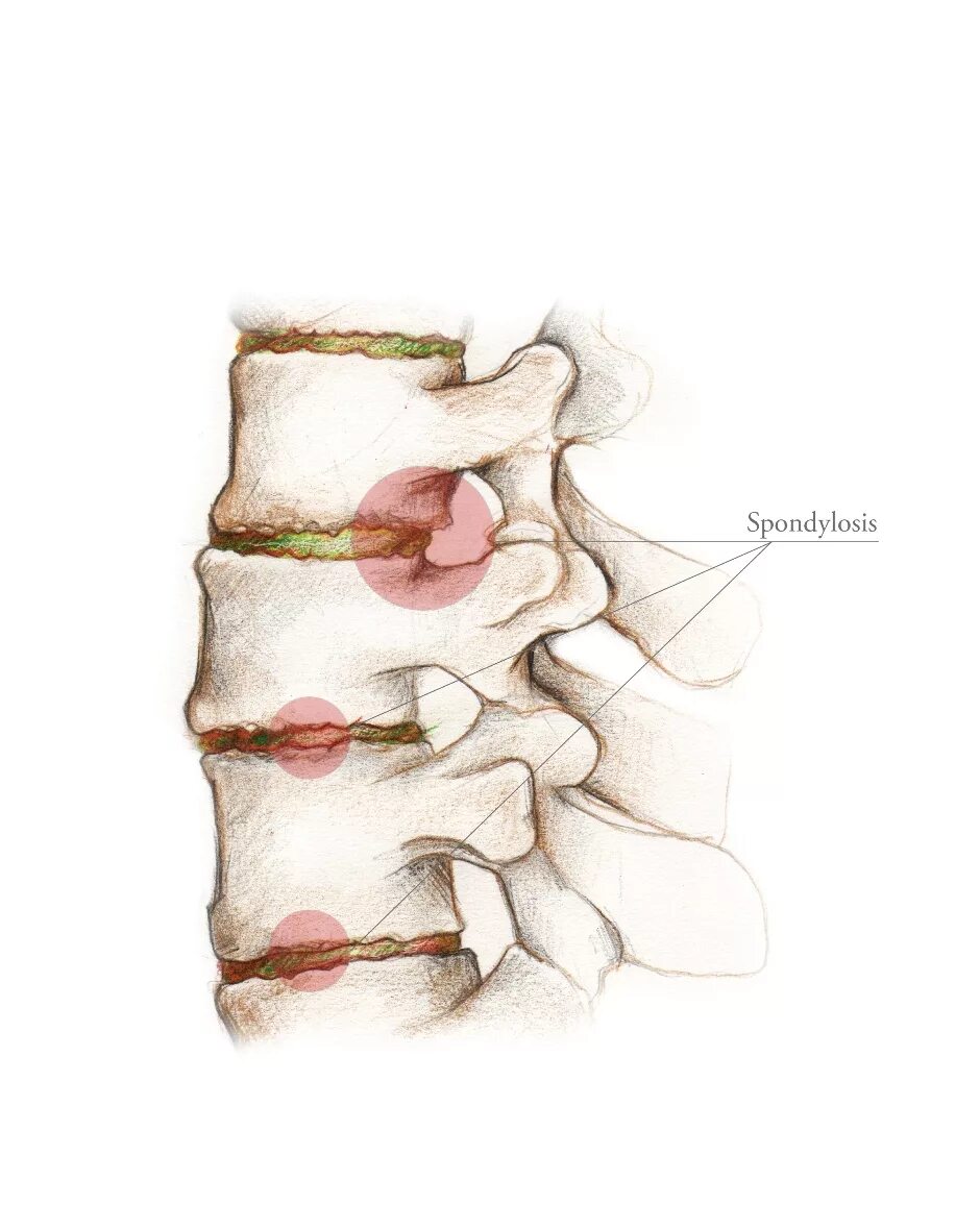 L5-s1. Деформирующий спондилез. Спондилез с4- с6. Остеофиты спондилез. Спондилез l3-l5 что такое. Картина спондилеза