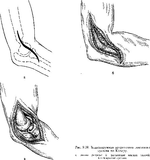 Артротомия плечевого сустава. Артротомия локтевого сустава. Пункция и артротомия локтевого сустава. Артротомия локтевого сустава по Войно-Ясенецкому. Артротомия локтевого сустава по Кохеру.