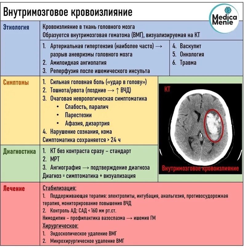 Brain 161. Внутримозговое кровоизлияние. Субкортикальное кровоизлияние. Классификация внутримозговых кровоизлияний. Внутримозговая гематома неврология.