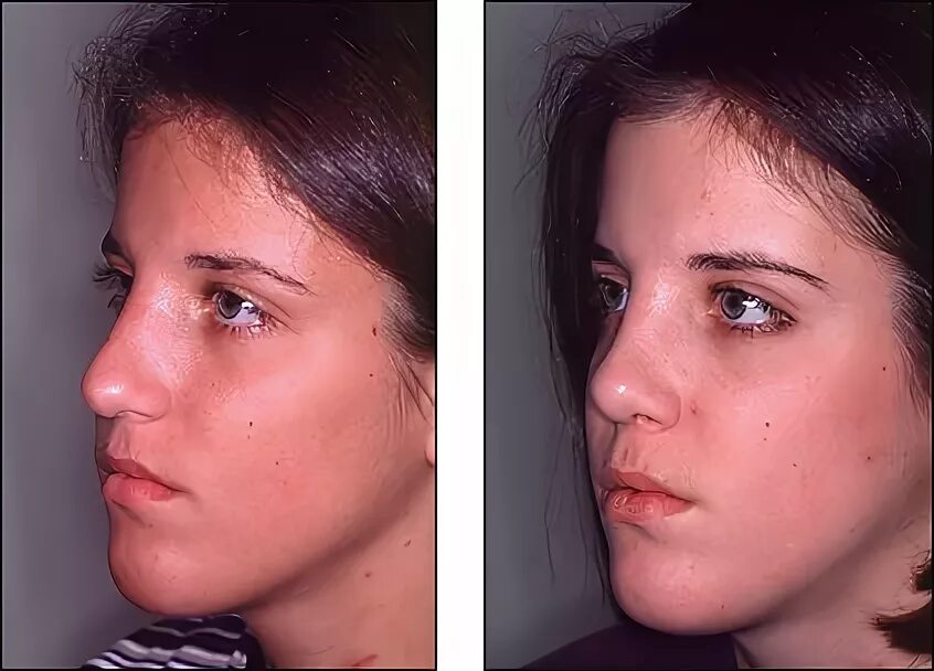 Нос до и после ринопластики. Ринопластика носа в 15 лет. Ринопластика в 14 лет.